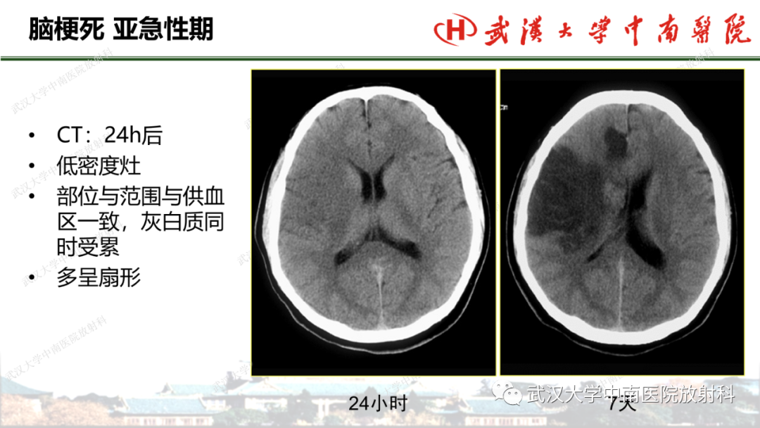 影像PPT - 【PPT】脑梗死的影像学表现-30
