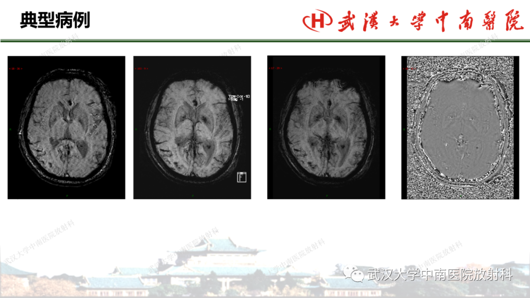 影像PPT - 【PPT】脑梗死的影像学表现-45