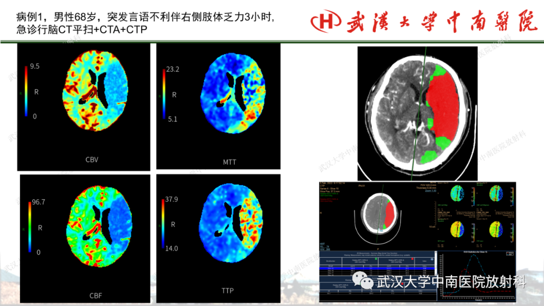 影像PPT - 【PPT】脑梗死的影像学表现-33