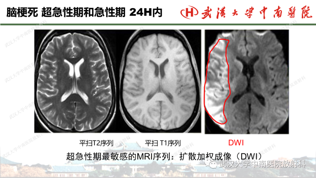 影像PPT - 【PPT】脑梗死的影像学表现-29