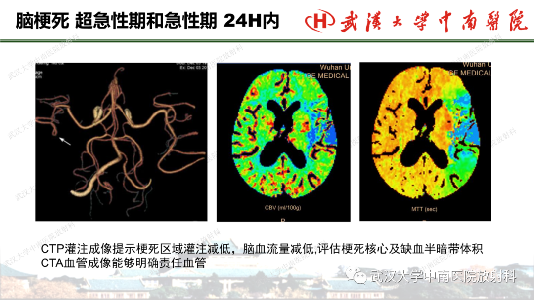 影像PPT - 【PPT】脑梗死的影像学表现-27