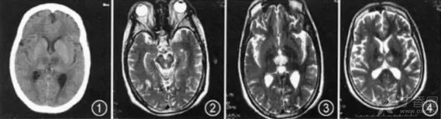 影像PPT - 累及双侧丘脑的 15 种疾病,除了脑梗死,你还见过哪几个?-2 影像PPT - 累及双侧丘脑的 15 种疾病,除了脑梗死,你还见过哪几个?-2