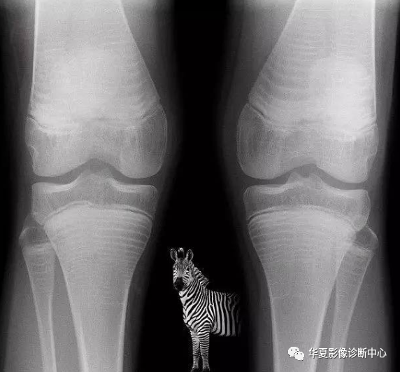 影像PPT - 斑马纹征-1 影像PPT - 斑马纹征-1