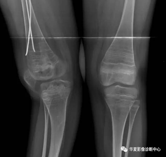 影像PPT - 斑马纹征-2 影像PPT - 斑马纹征-2