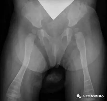 影像PPT - 斑马纹征-3 影像PPT - 斑马纹征-3