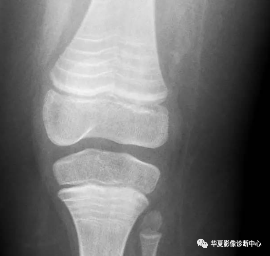 影像PPT - 斑马纹征-4 影像PPT - 斑马纹征-4