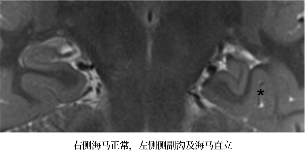 影像PPT - 海马MRI解剖及相关病变的影像表现-13 影像PPT - 海马MRI解剖及相关病变的影像表现-13