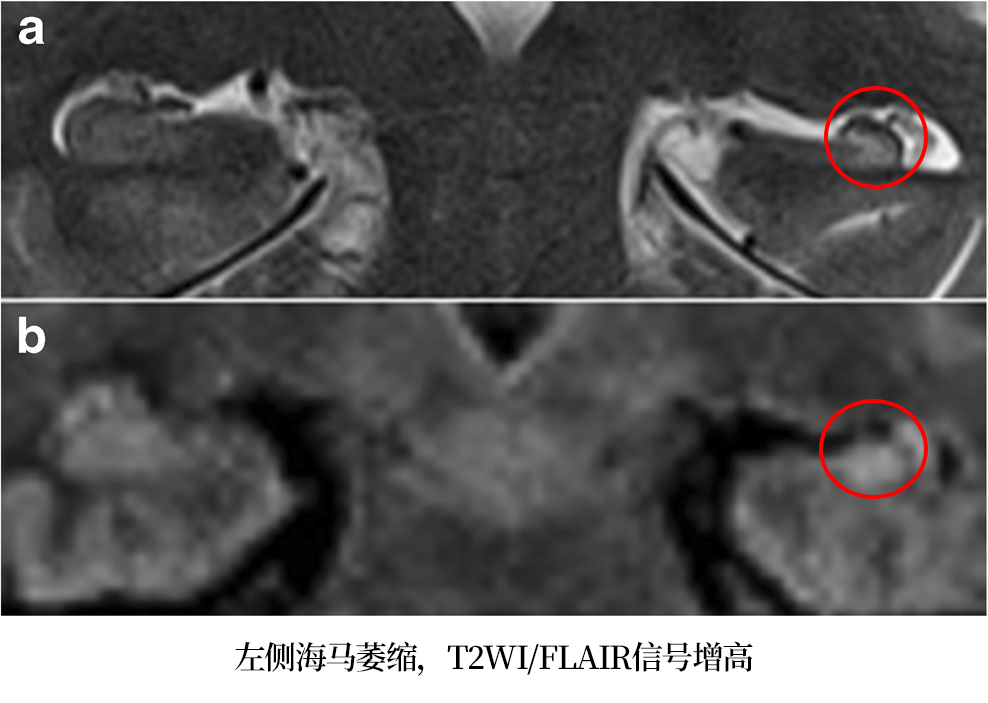 影像PPT - 海马MRI解剖及相关病变的影像表现-15 影像PPT - 海马MRI解剖及相关病变的影像表现-15