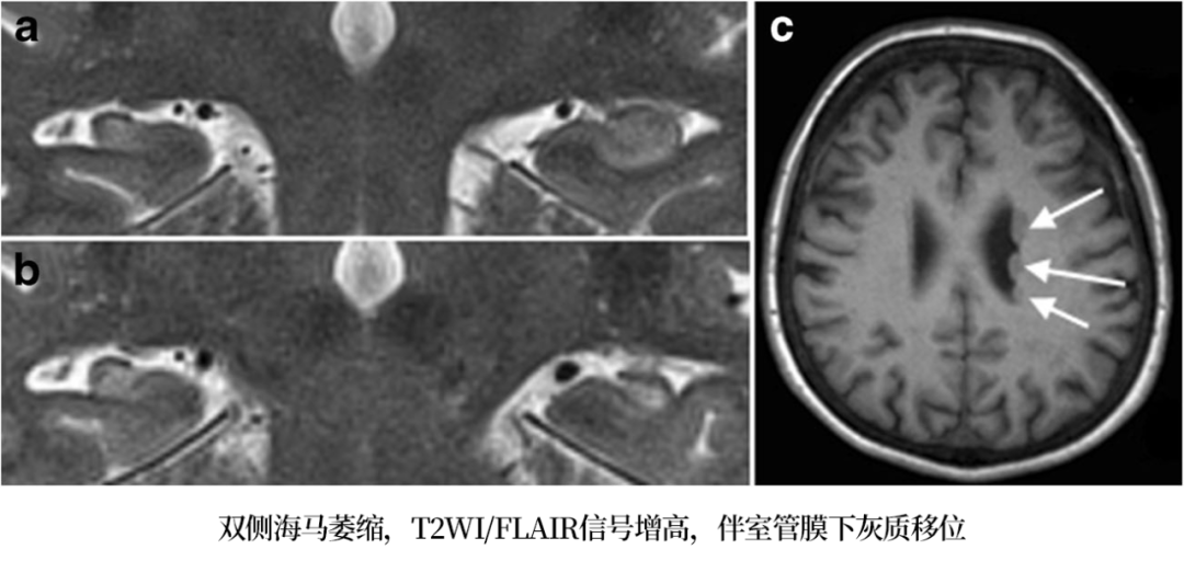 影像PPT - 海马MRI解剖及相关病变的影像表现-16 影像PPT - 海马MRI解剖及相关病变的影像表现-16