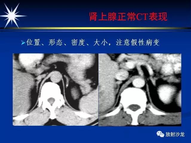 影像PPT - 【PPT】肾上腺影像学诊断-7