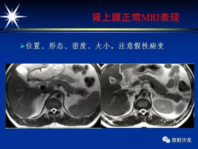 影像PPT - 【PPT】肾上腺影像学诊断-8