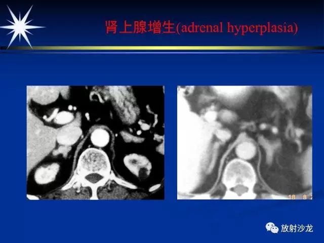 影像PPT - 【PPT】肾上腺影像学诊断-20