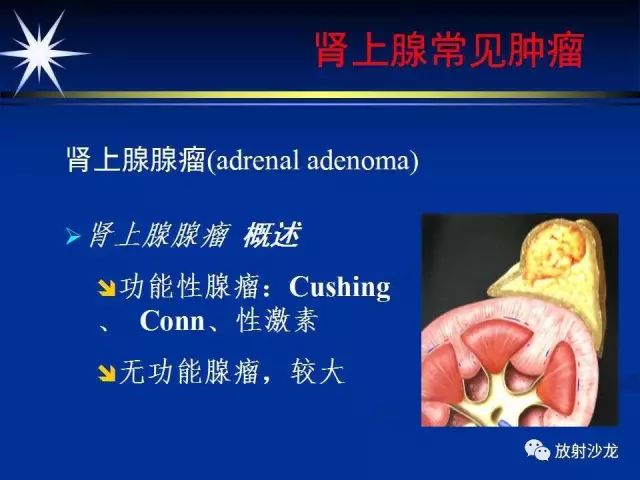 影像PPT - 【PPT】肾上腺影像学诊断-21