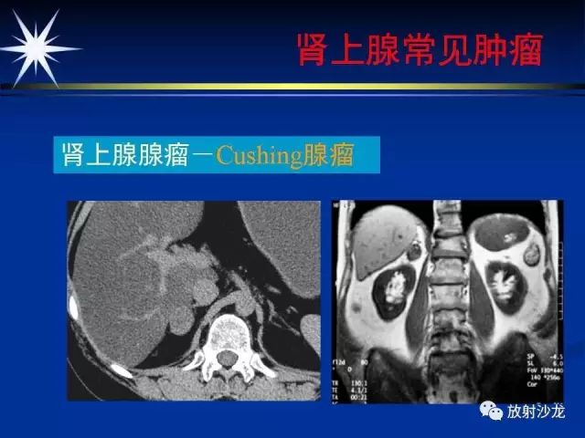 影像PPT - 【PPT】肾上腺影像学诊断-25