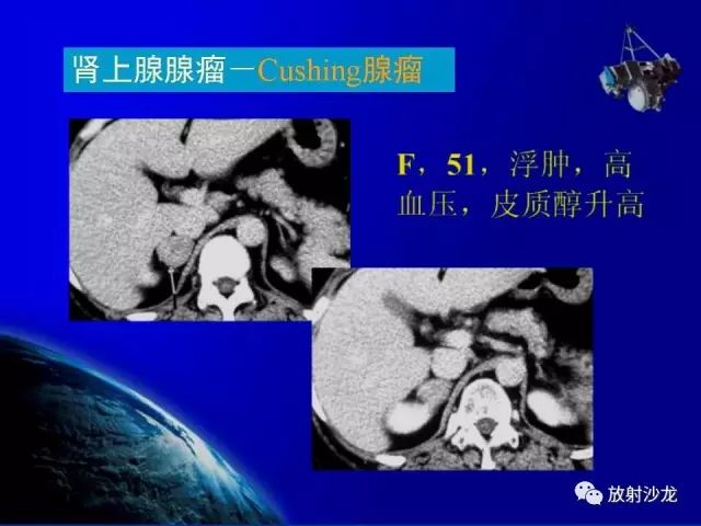 影像PPT - 【PPT】肾上腺影像学诊断-26