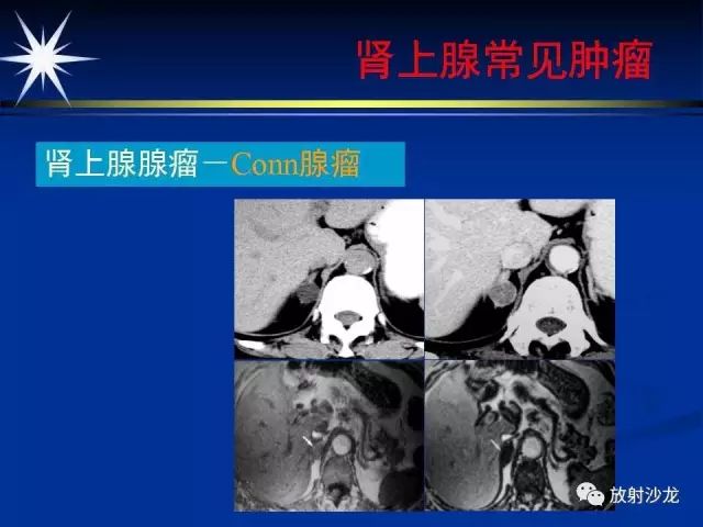影像PPT - 【PPT】肾上腺影像学诊断-27