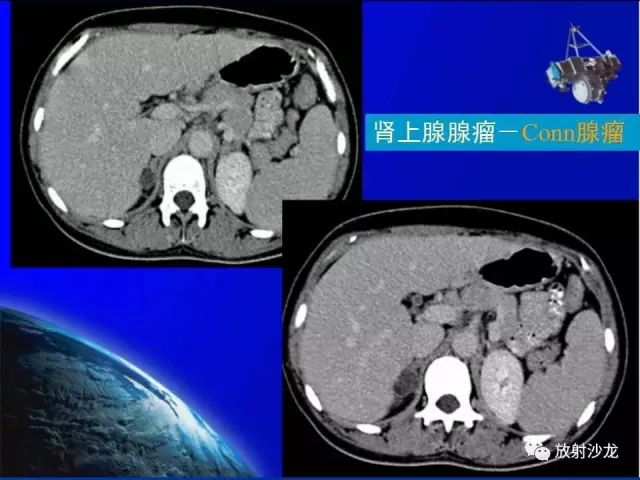影像PPT - 【PPT】肾上腺影像学诊断-28