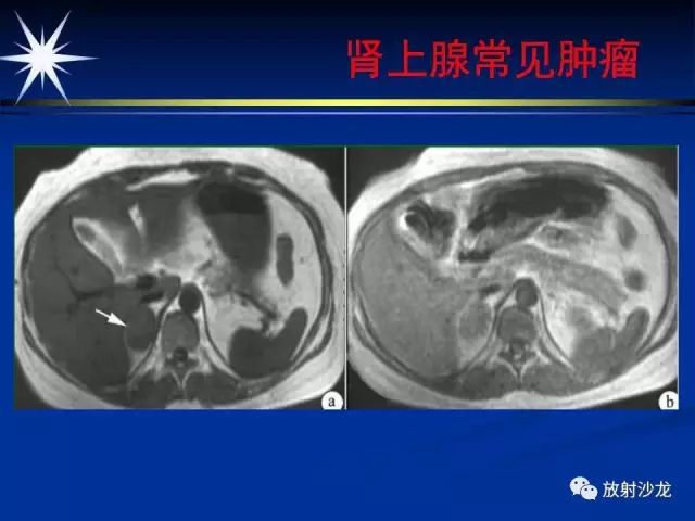 影像PPT - 【PPT】肾上腺影像学诊断-29