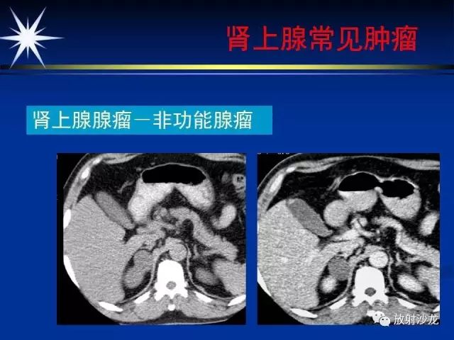 影像PPT - 【PPT】肾上腺影像学诊断-30