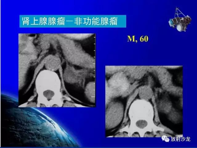 影像PPT - 【PPT】肾上腺影像学诊断-31