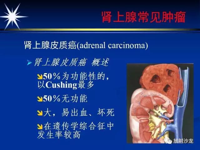 影像PPT - 【PPT】肾上腺影像学诊断-32