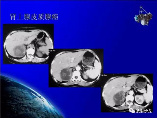 影像PPT - 【PPT】肾上腺影像学诊断-35