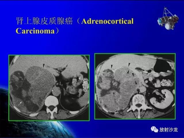 影像PPT - 【PPT】肾上腺影像学诊断-36