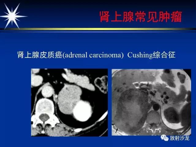 影像PPT - 【PPT】肾上腺影像学诊断-38