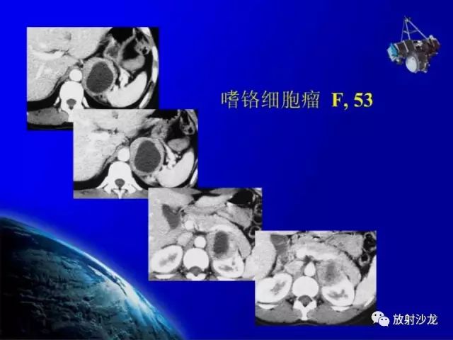 影像PPT - 【PPT】肾上腺影像学诊断-41