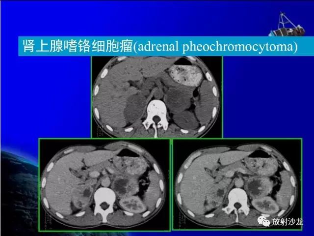 影像PPT - 【PPT】肾上腺影像学诊断-42