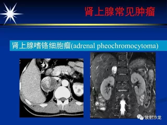 影像PPT - 【PPT】肾上腺影像学诊断-43