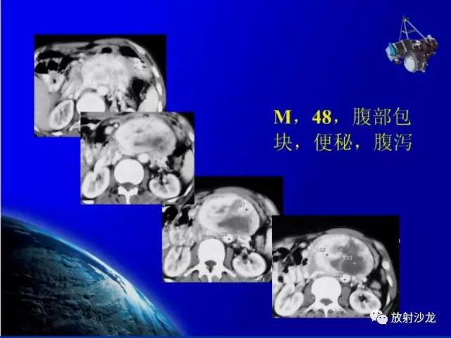 影像PPT - 【PPT】肾上腺影像学诊断-44