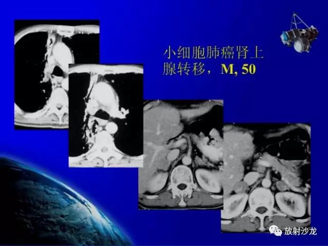 影像PPT - 【PPT】肾上腺影像学诊断-47