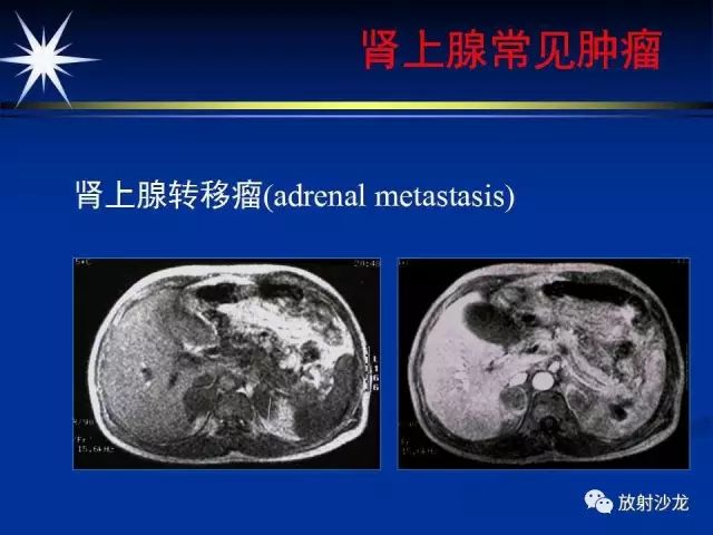 影像PPT - 【PPT】肾上腺影像学诊断-48