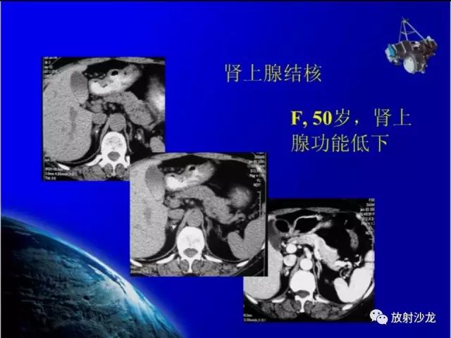 影像PPT - 【PPT】肾上腺影像学诊断-51