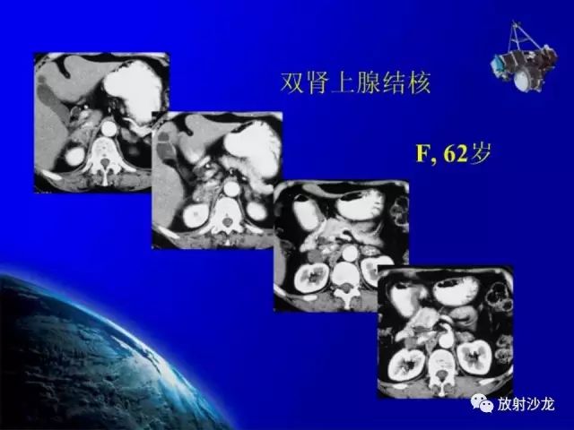 影像PPT - 【PPT】肾上腺影像学诊断-52