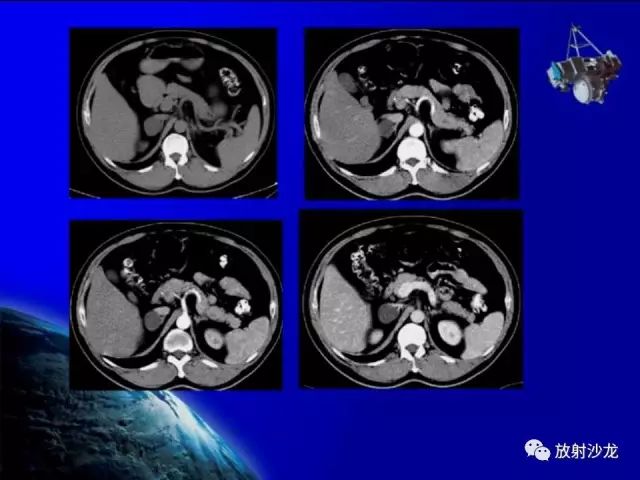 影像PPT - 【PPT】肾上腺影像学诊断-56
