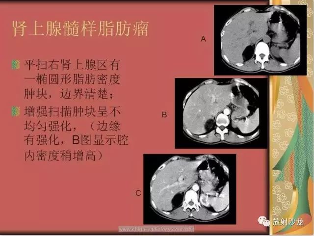 影像PPT - 【PPT】肾上腺影像学诊断-60