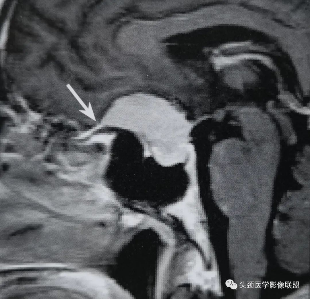 影像PPT - 【病例】皮细胞型脑膜瘤1例影像诊断-3 影像PPT - 【病例】皮细胞型脑膜瘤1例影像诊断-3