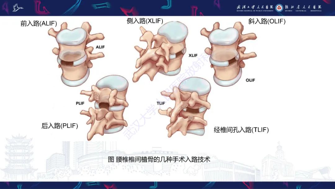 影像PPT - 【PPT】脊柱术后CT评估-12