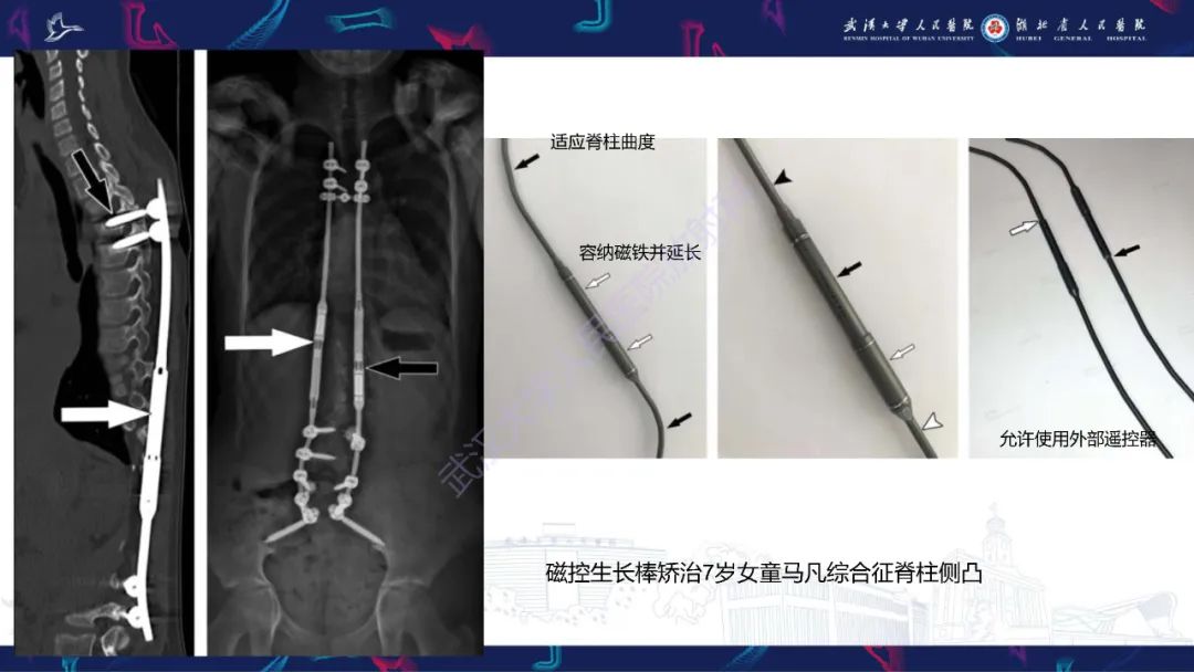 影像PPT - 【PPT】脊柱术后CT评估-16