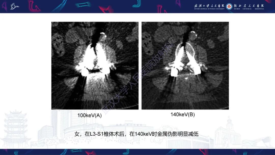 影像PPT - 【PPT】脊柱术后CT评估-9