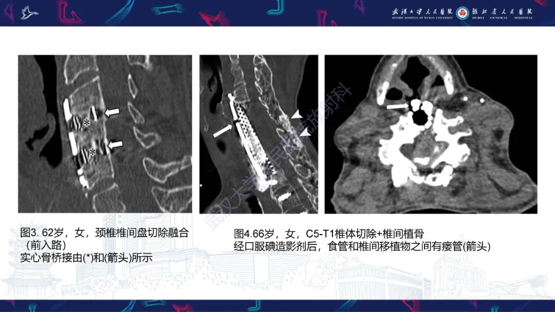 影像PPT - 【PPT】脊柱术后CT评估-19