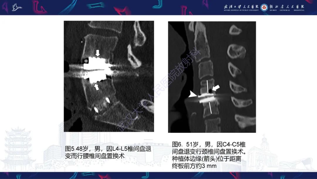 影像PPT - 【PPT】脊柱术后CT评估-20