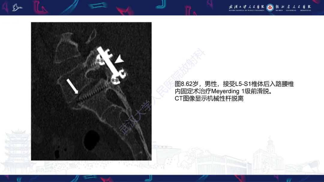 影像PPT - 【PPT】脊柱术后CT评估-22