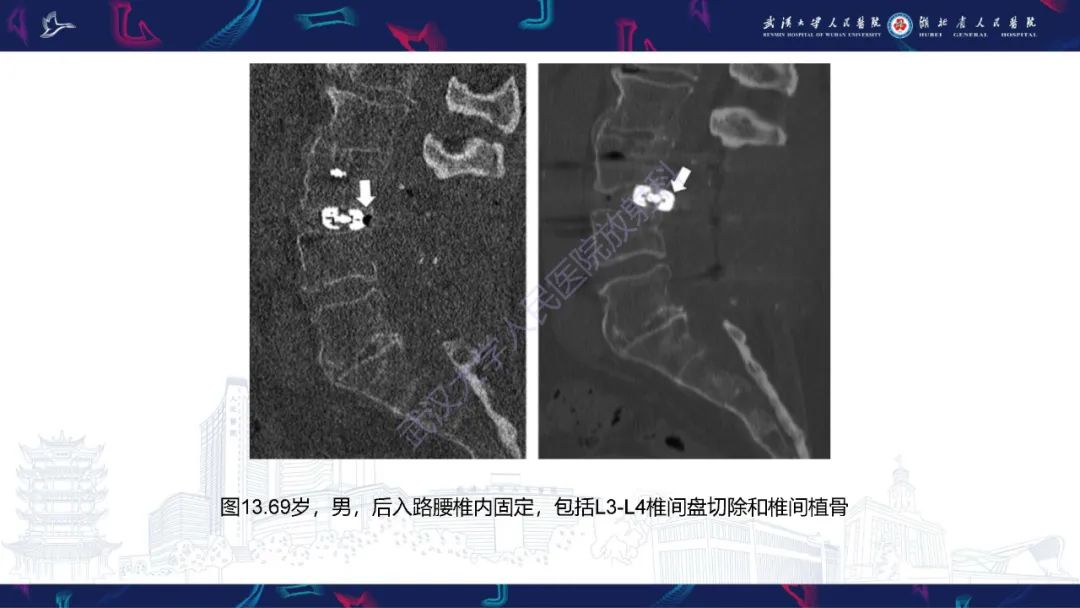 影像PPT - 【PPT】脊柱术后CT评估-27