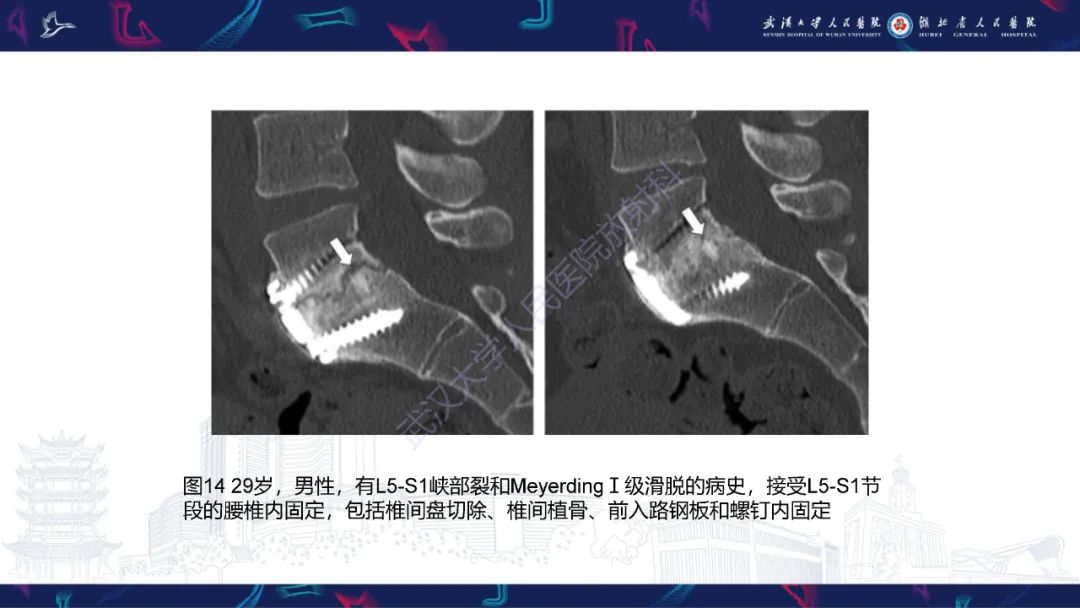影像PPT - 【PPT】脊柱术后CT评估-28