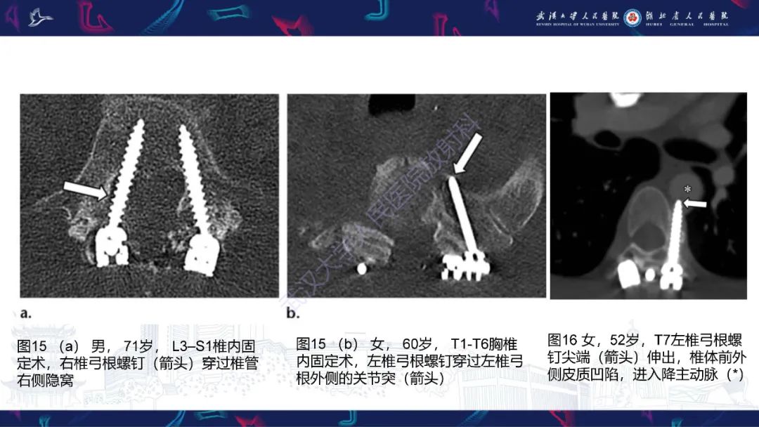 影像PPT - 【PPT】脊柱术后CT评估-31