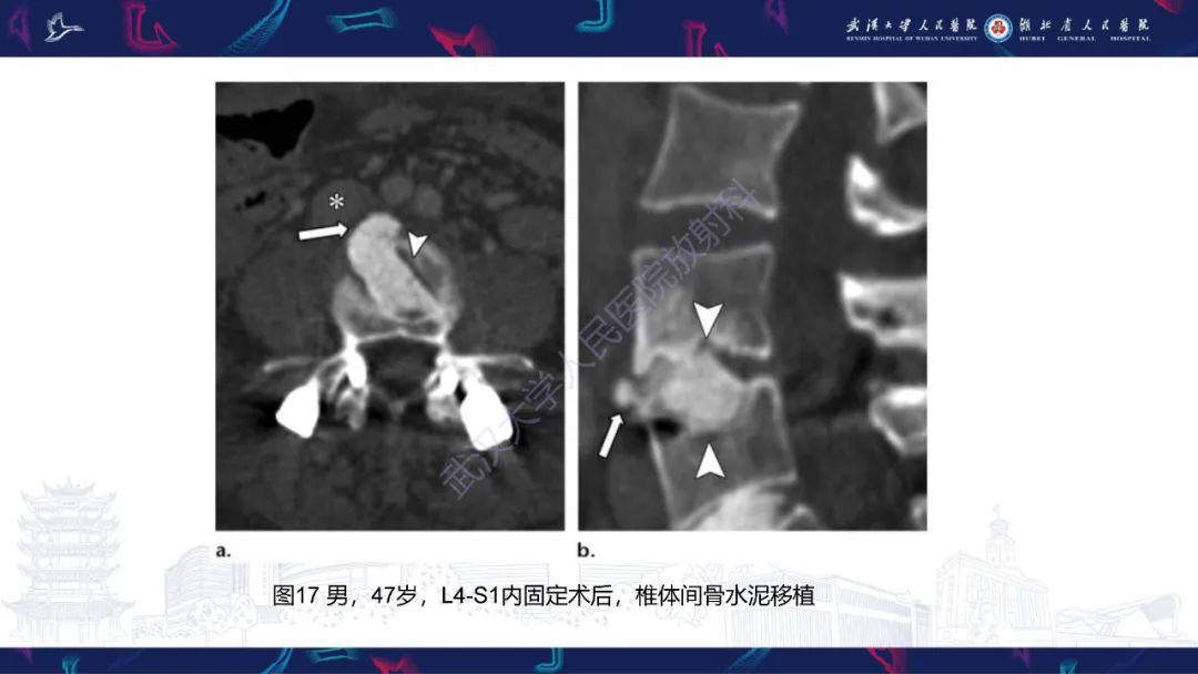 影像PPT - 【PPT】脊柱术后CT评估-33