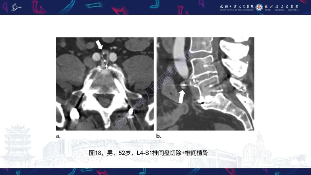 影像PPT - 【PPT】脊柱术后CT评估-34